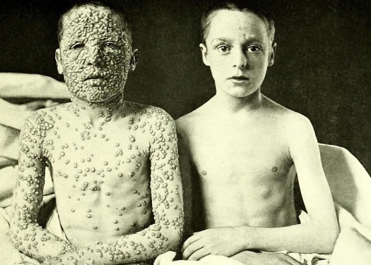 Two boys with smallpox, one vaccinated, one not. Allan Warner, 1901